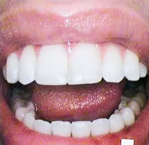 Crown After