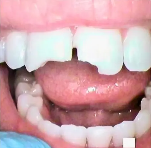 Crown Before