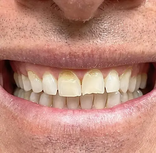 Veneers Before