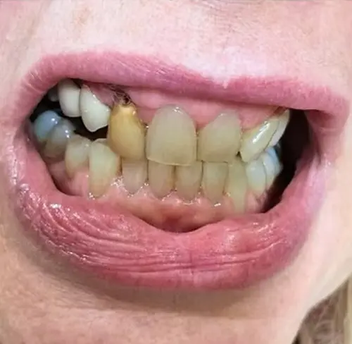 Veneers Before