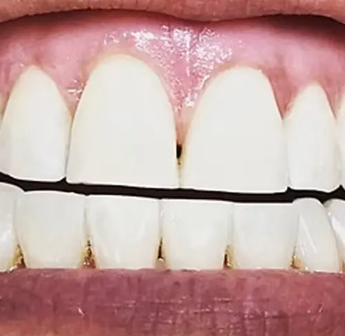 Whitening After